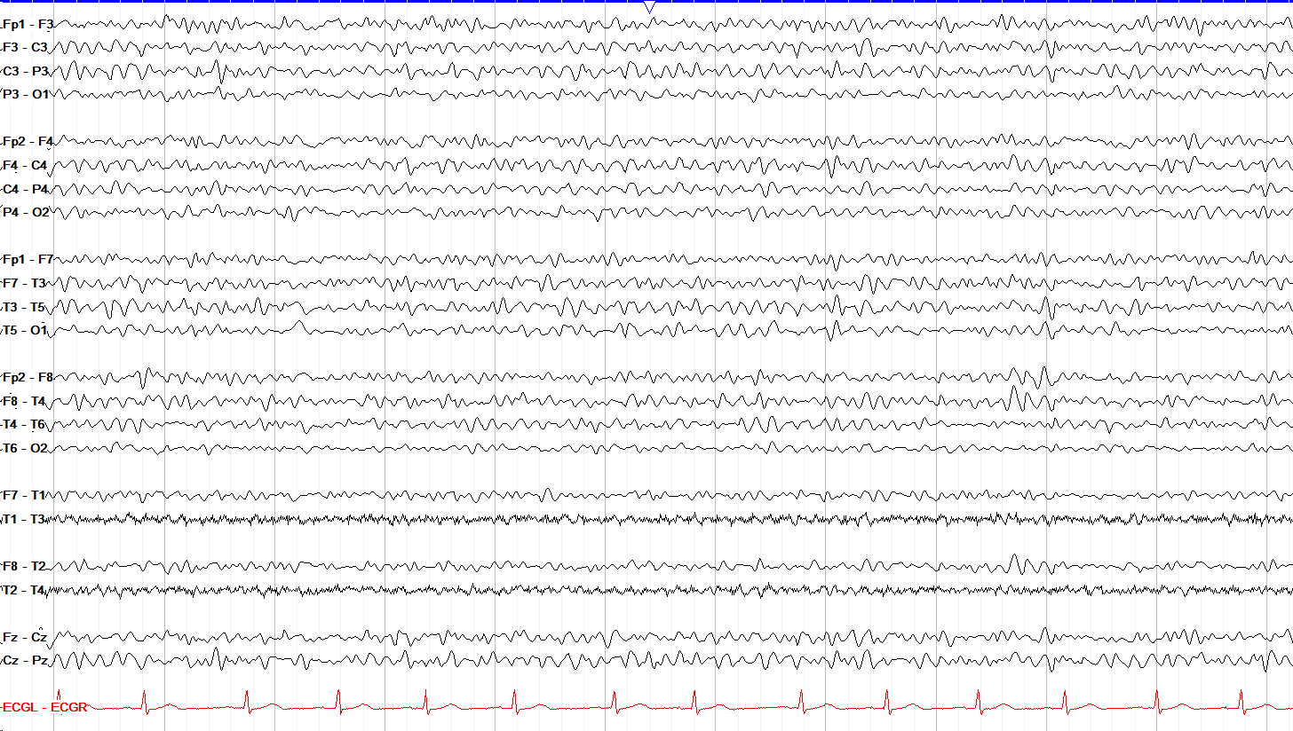 EEG Terminology and Waveforms